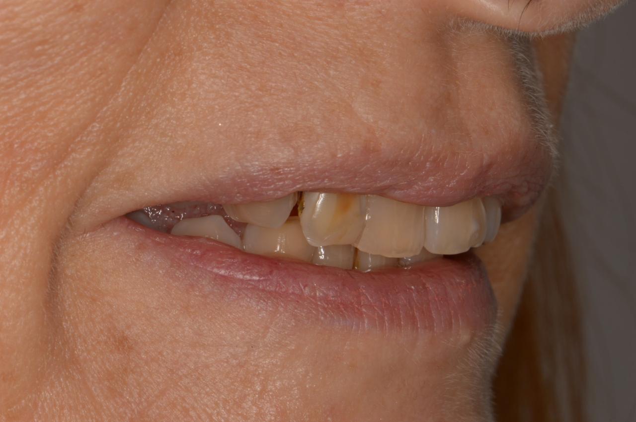 Paciente rehabilitada con implantes y coronas de porcelana pura.