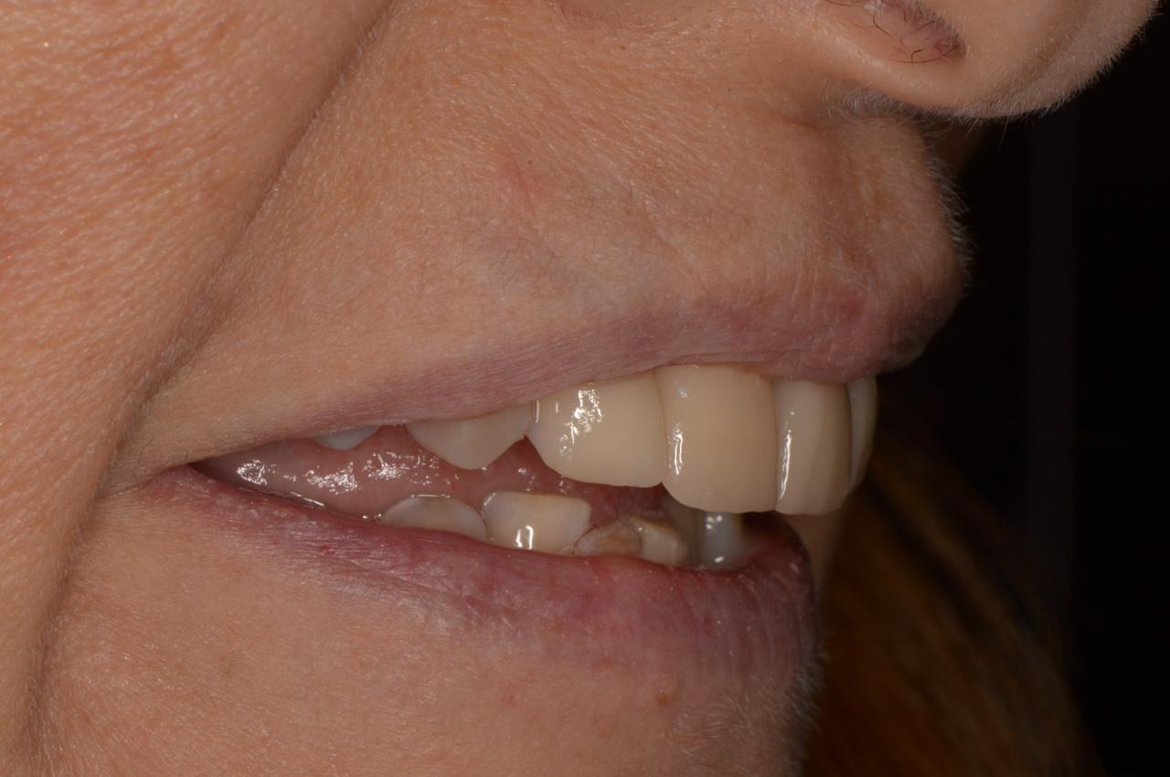 Paciente rehabilitada con implantes y coronas de porcelana pura.