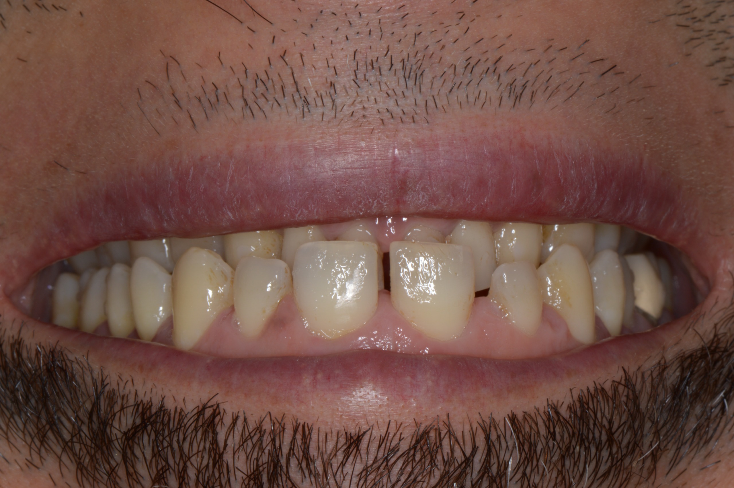 A nuestra paciente le realizamos carillas de cerámica E-MAX.