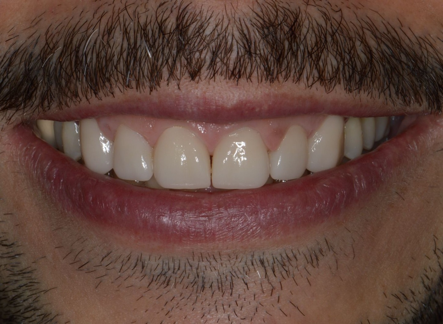 A nuestra paciente le realizamos carillas de cerámica E-MAX.