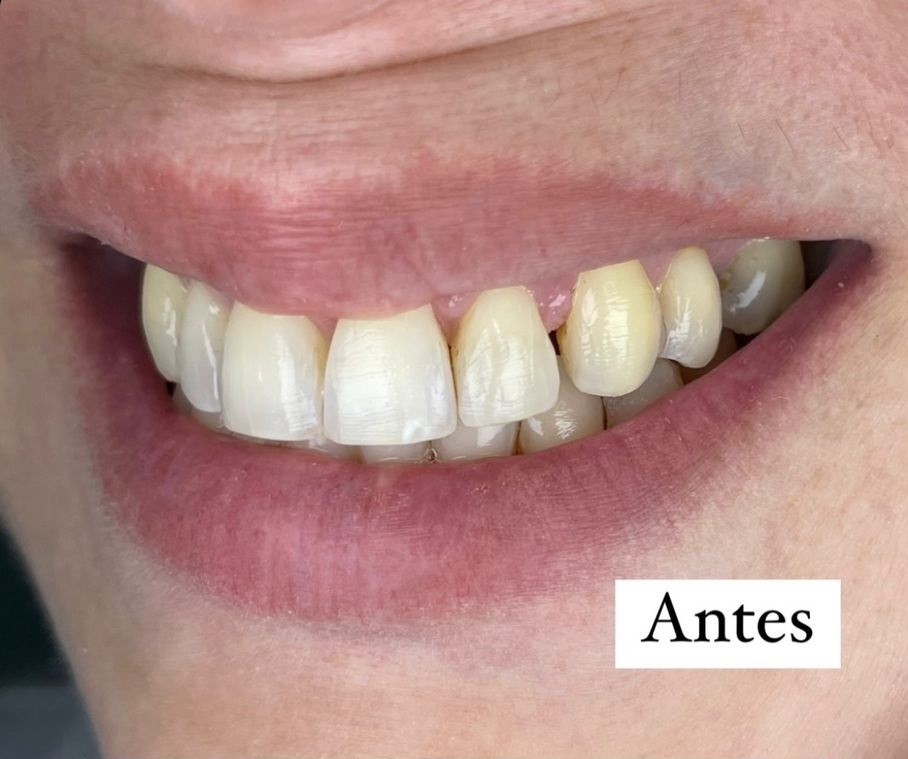 Antes y despues de nuestro blanqueamiento de consultorio