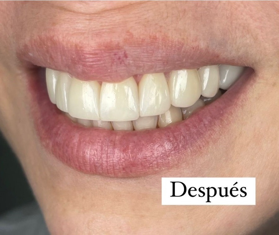 Antes y despues de nuestro blanqueamiento de consultorio